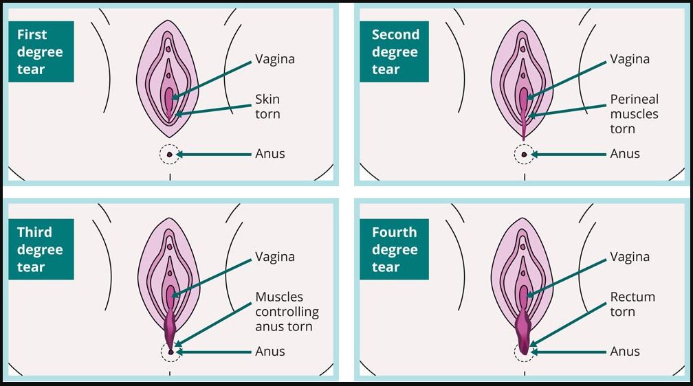 A picture of degrees 1-4 of perineal tears