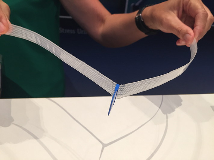Mid-urethral sling (MUS)