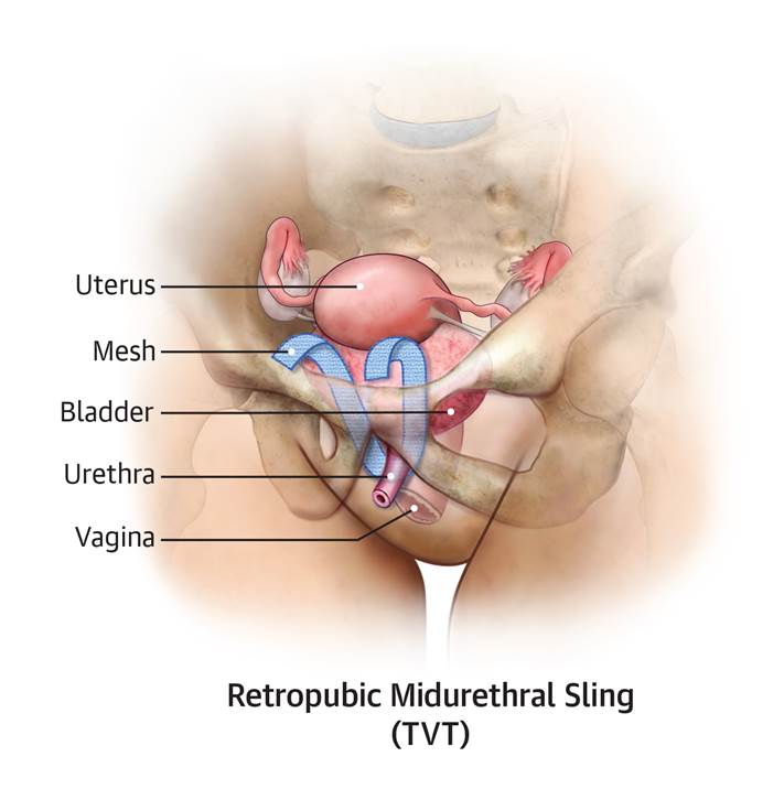 Retropubic Midurethral Sling