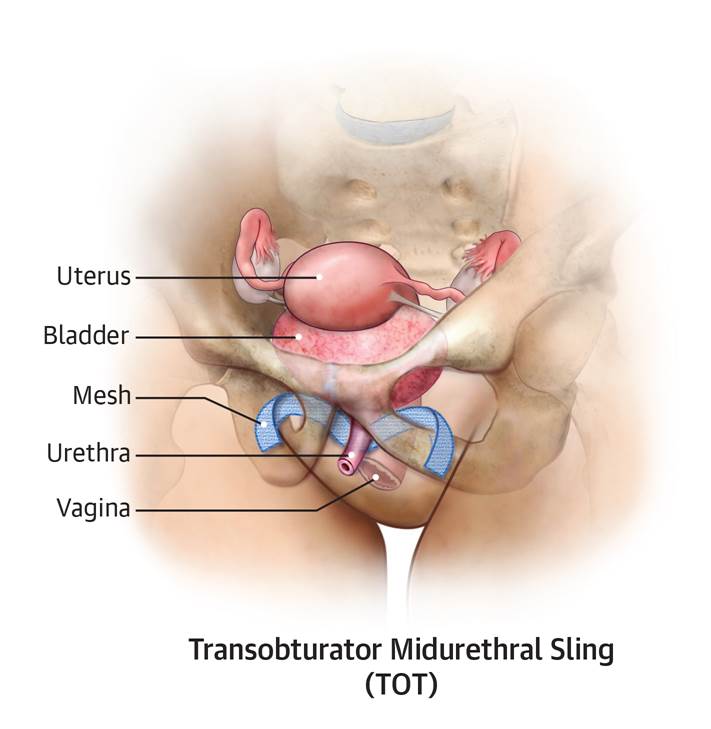 Transobturator Mid-urethral Sling