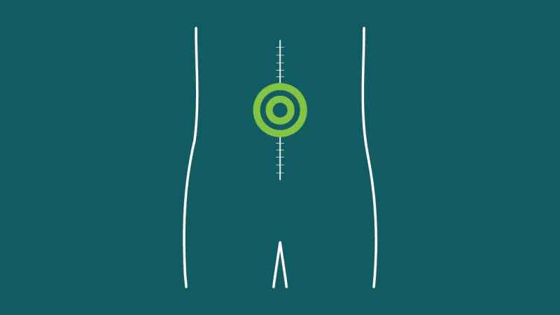 Emergency Laparotomy CCS Campaign